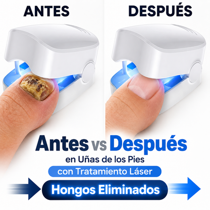 Elimina Hongos Rápido, Sin Dolor y con Resultados Visibles